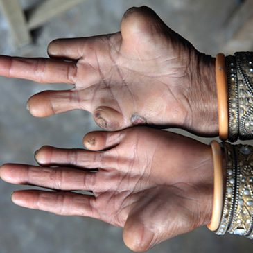 How a Swiss doctor and a Swiss volunteer changed my thoughts about leprosy patients